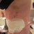 Day 4 - post op side view (with lipo bruising)
