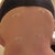 Day 4 - post op back view (little lipo holes)