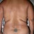 BEFORE BRAZILIAN & LIPO OF BACK
