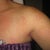 Rash from antiseptic cleaner used during surgery