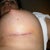 Left  breast suture