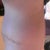 12 weeks post op