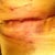 Incision