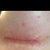 Incision on day 13, they both look the same, skin is irritated because of the sterile strips I had.