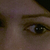 Tear-troughs after filler