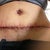 3 days post op, after staples and drains came out