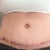 11 day post op laying down
