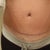 10 weeks post op