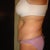 I have very little fat on my arms, hips, thighs, or butt.  All in the tummy and flanks.