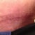 Wow look at my scar.  6 weeks and I can barely see it.  Amazing.