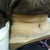 1 day post op side view
