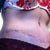 6 weeks po - close up of incision.. stretch marks make it a little bump hoping it settles a bit more but still very happy with the contour of my tummy now :)