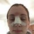 Day 2. Swelling not too bad, feeling pretty good. Nose stopped bleeding so I took off the drip pad.