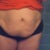 Night before surgery. Front view