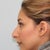 Before - Side Profile