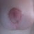 3 weeks post op, irritation from surgical tape