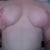 3 weeks post op