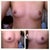 This is me at pre-opp. 34A & You can see the asymmetry of both breasts. Left is bigger than right breast.