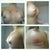 Post Opp Day 1 pictures at different angles. You can still see the marking from my surgery. I'm very swollen and implants are pretty high. Right breast has 570 cc, left breast has 550 cc. Moderate profile, saline implant and behind the muscle.