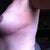 9 wks, close up side scar