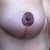 9 wks, close up vertical and areola scar