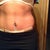 6 weeks post op still swollen right side might need insicion correction not tight