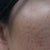 Before Treatment - Left Side
