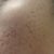 Before Treatment - Right Side