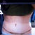After-10 days post op front view