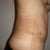 1 Week Post-op