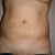 1 Week Post-Op