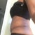 7 weeks post op left side