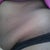 Side Dunlap view/Flap of Skin result of C-sections
