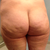 Day 13 - Back Side - as you can tell, it looks like the same cellulite that was originally there. I'm going to hold out until 6 or more weeks until I decide if it was worth it or not.  I'm being patient and expecting results for the $7k I paid.