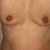 12 days after op.