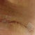 Incision on right side where I had a suture that my friend removed. Jagged n weird but below panty line. This is almost 3 weeks post op.