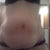 Fat and deformed bellybutton from prev surgery
