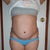 4 months post op Front
Look at the right side and left, they dont look right .. the right side pokes out more.. Had revision done
