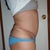 4 months post right
DUnno if u can tell from this angle how the pocket of fat pokes out
had revision done