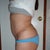 4 months post op left
will most likely have revision on this side done as well.