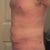 24hrs after procedure.