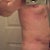24hrs after procedure. (That's my hand "down there"..not my manhood!)