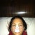 Night of surgery, after icing all day, not very swollen or bruised.