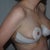 One day post-op, showing bruising from lipo under the arms. Oof, that hurt.