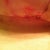 T-junction opening...some of the redness is from the steri strips they pulled off.