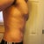 12 months, side, slight angle to show loose skin on lower abdomen.