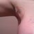 Dent On Outside of Armpit/Chest