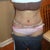 Tummy tuck post op