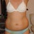stretch marks are from being on Prednisone for 12 years.