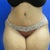 6 week post op